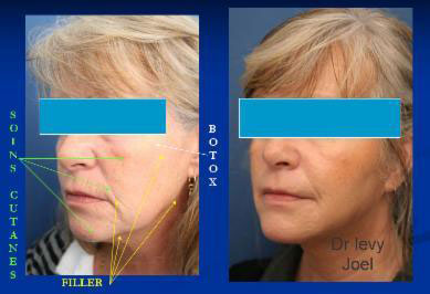 Botox, Injections, Mesolift