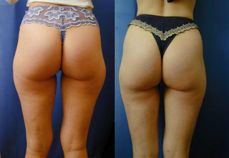 Liposuction