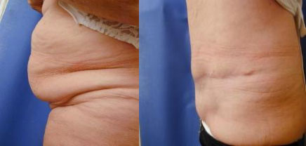 Abdominoplasty