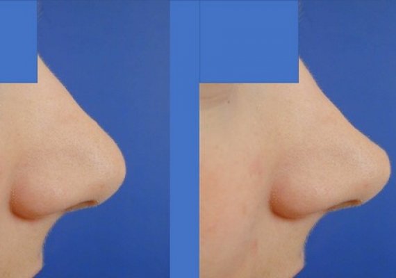 Nose/ Rhinoplasty