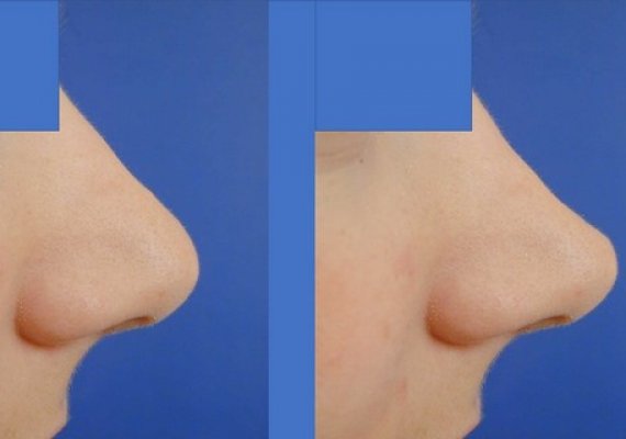 Nez / Rhinoplastie