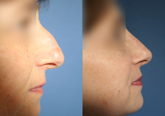 Nose/ Rhinoplasty