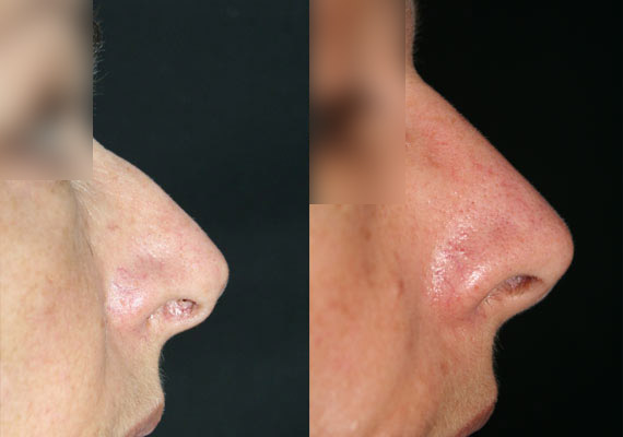 Nez / Rhinoplastie