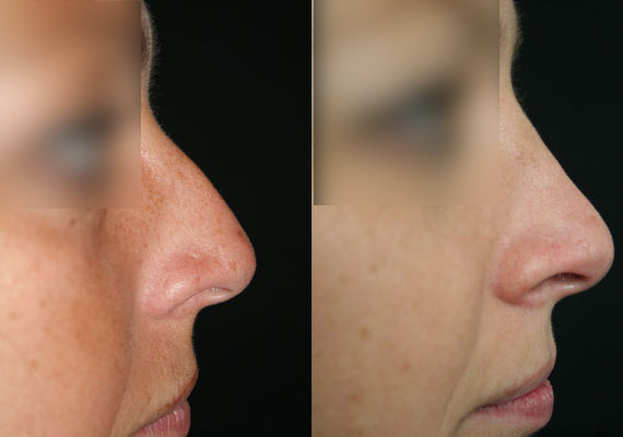 Nez / Rhinoplastie