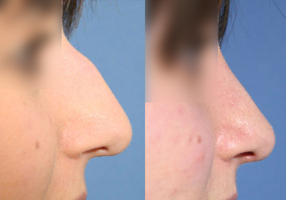 Nose/ Rhinoplasty