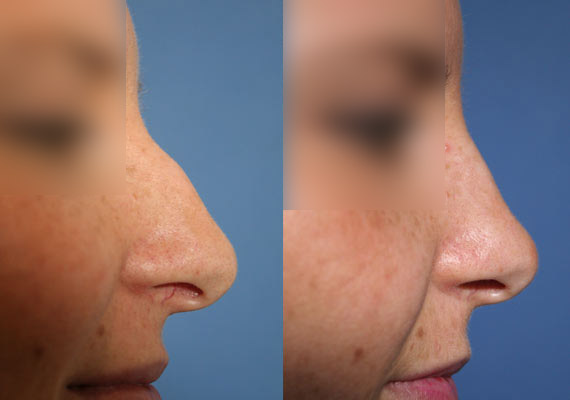 Nose/ Rhinoplasty